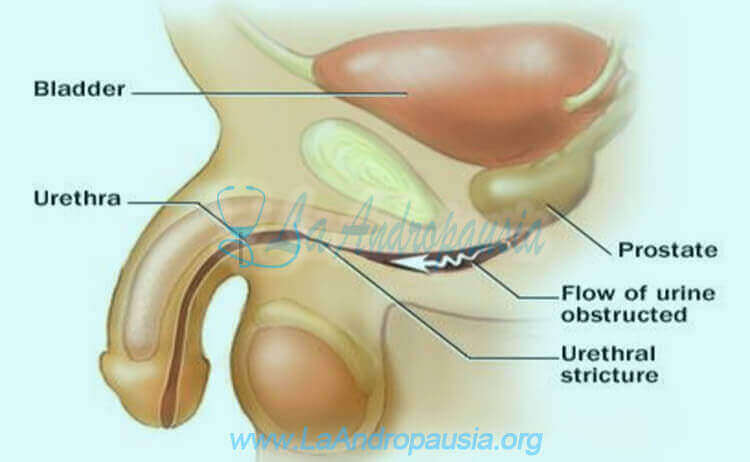 Estenosis uretral - Qué es