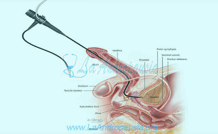 Estenosis uretral - Tratamiento