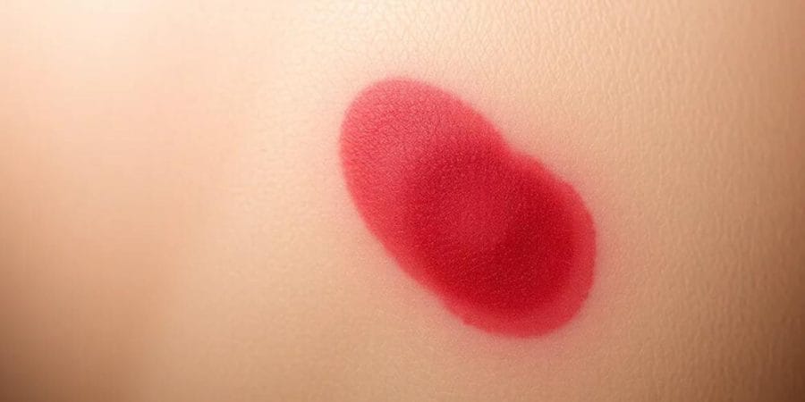 Importancia de la revisión dermatológica periódica
