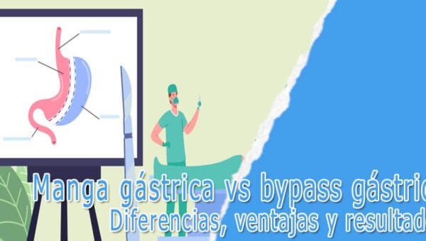 Manga gástrica vs bypass gástrico