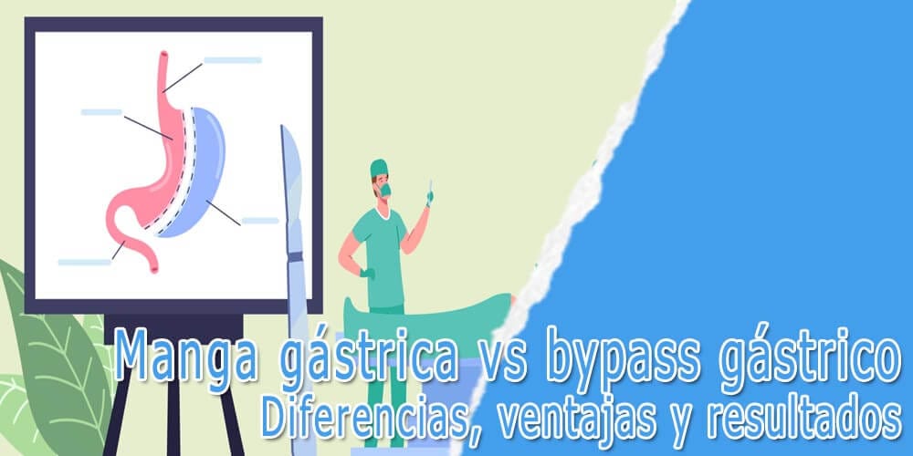 Manga gástrica vs bypass gástrico