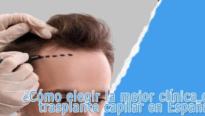 ¿Cómo elegir la mejor clínica de trasplante capilar en España? 20 Mejor clínica de trasplante capilar en españa